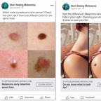 Three social media ads with images of melanoma and moles on skin.